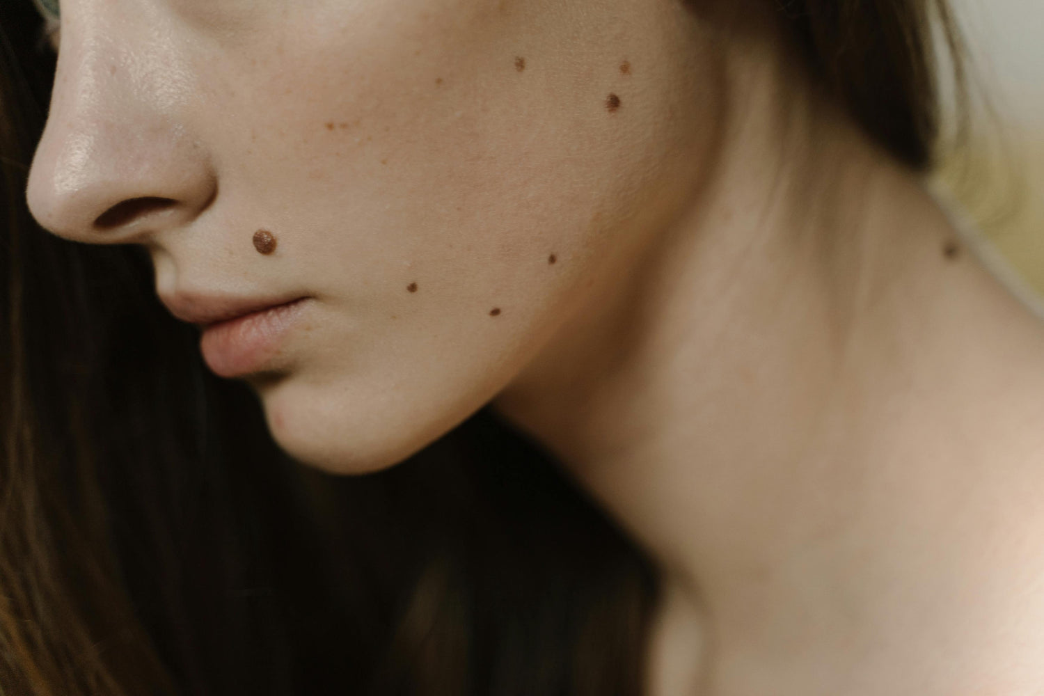 Primer plano del rostro de una mujer con manchas e hiperpigmentación, ejemplo de pieles tratables con activos despigmentantes dermatológicos